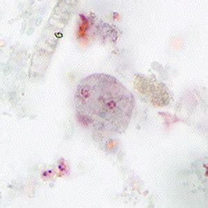  Dientamoeba Fragilis:  The Tiny Troublemaker That Could Be Lurking Inside You Right Now!